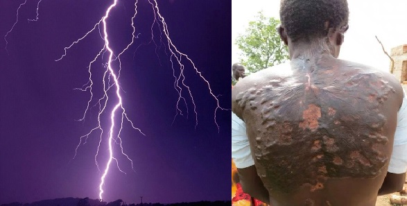 People hit by lightning reveal their scars which look like fern leaves  (Photos) - YabaLeftOnline
